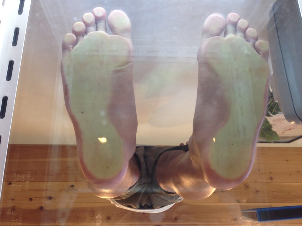 足底筋膜炎の足裏の評価